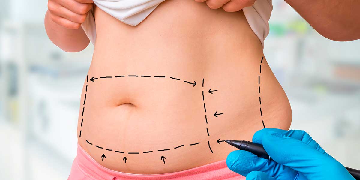 Liposuction in Karachi 3 - Dr Zia Plastic Surgery